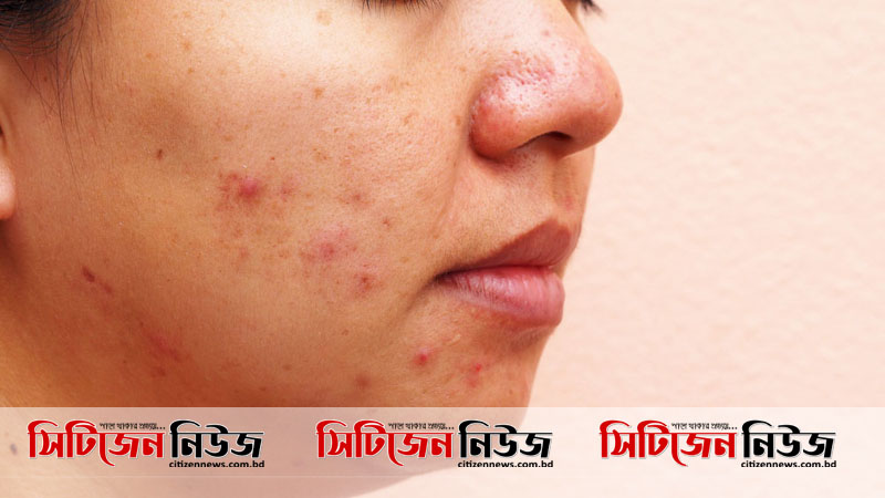 বয়স বাড়লেও পিছু ছাড়ছে না ব্রণ, জেনে নিন কারণ