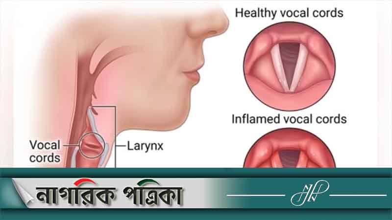 গলার স্বর বসে গেলে দ্রুত যা করবেন
